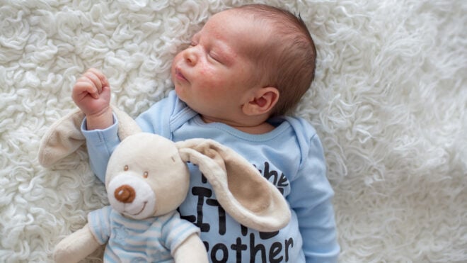 baby-boy-stuffie-baby-acne