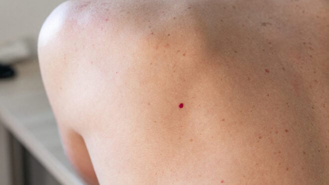 cherry angiomas