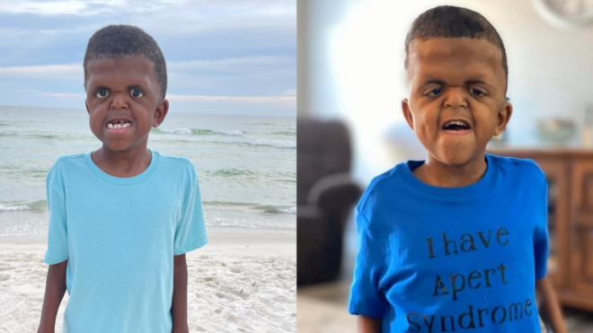 apert syndrome